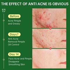 Acne Face Cream Herbal Pimple Scar Removal Shrink Pore