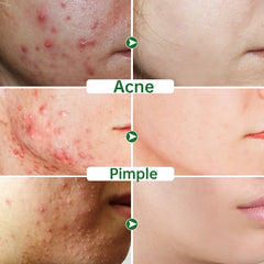 Acne Face Cream Herbal Pimple Scar Removal Shrink Pore