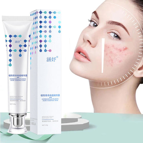 Face Cream Anti-Acne Gel Treatment  Acne Scar