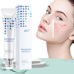 Face Cream Anti-Acne Gel Treatment  Acne Scar