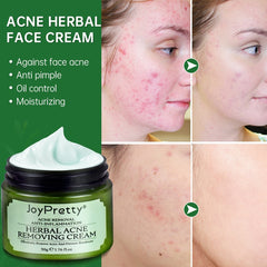 Acne Face Cream Herbal Pimple Scar Removal Shrink Pore